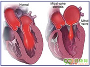 二尖瓣关闭不全