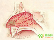 鼻血管瘤