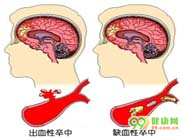 高血压脑出血